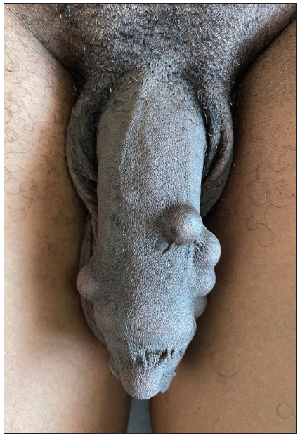 Penile implants, a cultural practice in the carceral milieu of French West Indies region: A case report